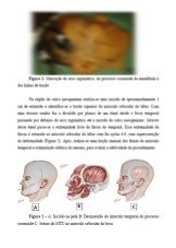 "Modificação da técnica de Gillies de transposição do músculo temporal na paralisias faciais periféricas tardias"