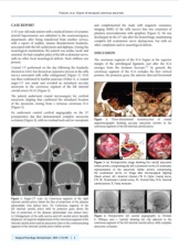 "Report of intradural aneurysm in the cavernous segment of the internal carotid artery presented with subarachnoid hemorrhage and oculomotor palsy"