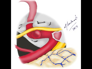 Intracranial aneurysm