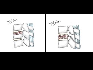 Fraturas vertebrais, subtipos: A3 e A4