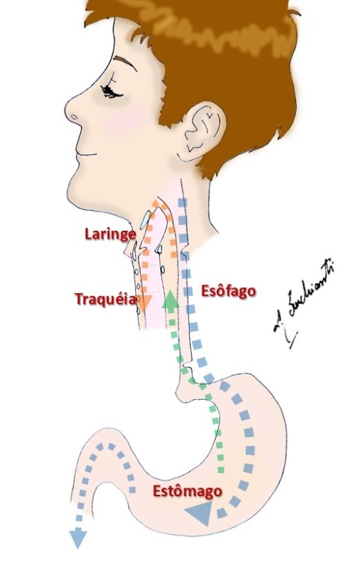 O refluxo laringofaringeo