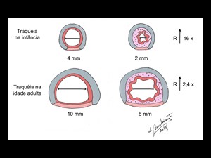 Comparação da traqueia infantil e do adulto