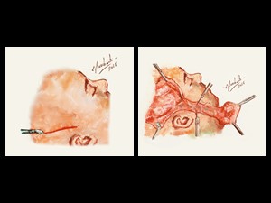 Retalho Pediculado Têmporo Parietal: Incisão e retalho rebatido