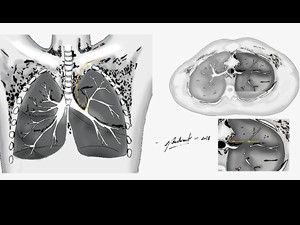 Pneumomediastino Espontâneo