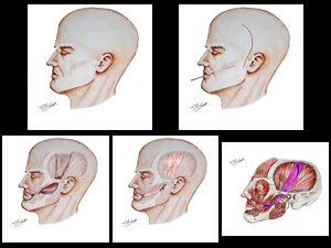 Transposição de Músculo Temporal pela Técnica de Gilles e Sofia et al
