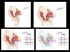 Introdução de pessário; POPQ