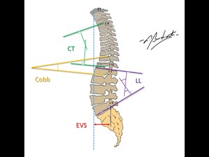 Cifose Torácica, Lordose Lombar, Ângulo de Cobb e Eixo Vertical Sagital