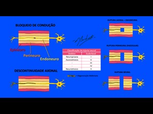 Bloqueios de Condução Nervosa e Rupturas Neurais