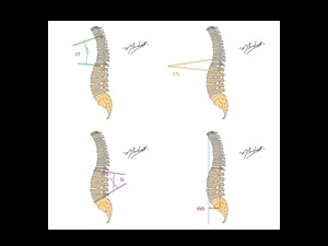 Cifose Torácica, ângulo de Cobb, Lordose Lombar, Eixo Vertical Sagital