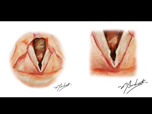 Nódulos Vocais e Micro Web Laríngeo