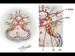 Emergência dos Nervos Craniano e Polígono de Willis: Vista Superior
