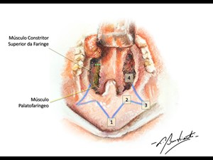 Faringoplastia Expansora